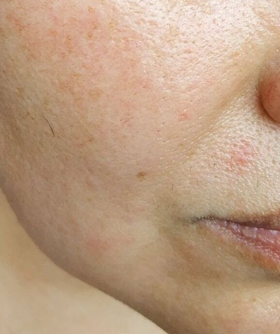 Intenskin si è sbarazzato delle profonde pieghe nasolabiali